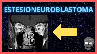 ESTESIONEUROBLASTOMA 👉Hallazgos radiológicos [upl. by Pippy]