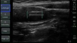 CIMT Exam  Performing Measurements  Sonosite [upl. by Niro]