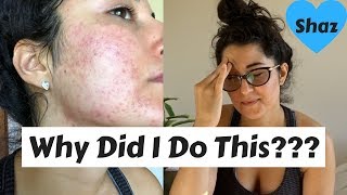 I Waxed My Face and This Is What Happened  TERRIBLE ACNE [upl. by Ybot16]