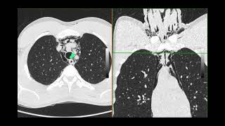 Pneumomediastinum [upl. by Israeli]