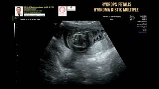 Hydrops Fetalis Hygroma Cystic [upl. by Minette]