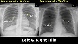 Normal Chest XRay Labelled Anatomy PA View Part 1 CXR Interpretation RibsHeartLungs Radiography [upl. by Enneira375]