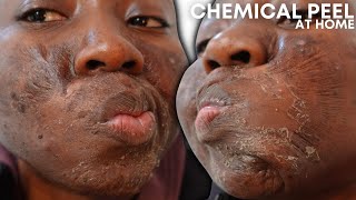 CHEMICAL PEEL FULL PROCESS AT HOME USING JESSNERS PEEL  BEFORE amp AFTER [upl. by Signe424]