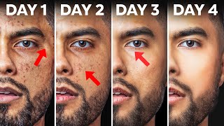 How To Fix Your Skin in 4 Days Use At Home Products [upl. by Ewald]