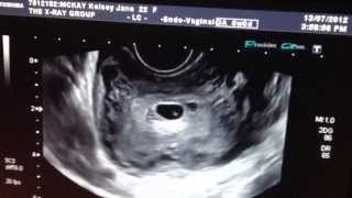 6 week pregnancy ultrasound SMALL SAC [upl. by Adamec319]