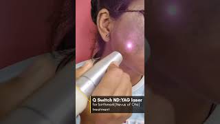 Birthmark removal Nevus of Ota By Q switch NdYAG laser ✅ [upl. by Ulita]