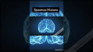 Spasmus Nutans [upl. by Anaili]