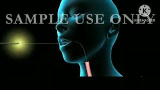 NG TUBE nasogastric tube or peg tube [upl. by Buckingham388]