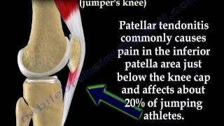 Patellar Tendonitis Jumpers Knee  Everything You Need To Know  Dr Nabil Ebraheim [upl. by Llebana435]