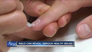 Doctors warn to check your nails for dangerous skin cancer [upl. by Guerra]