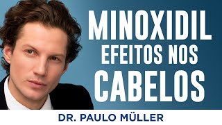 Qual Efeito Do Minoxidil Nos Cabelos – Dr Paulo Müller Dermatologista [upl. by Adnohsel]