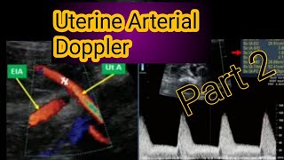 Obstetrics Doppler ultrasoundUterine artery Doppler ultrasound [upl. by Ginsburg]