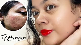 TRETINOIN Before amp After  My skin Transformation with Tretinoin pimple acnetreatment [upl. by Wolliw823]