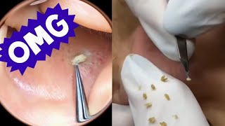 Ultimate Pimple Popping Compilation Satisfying Extractions amp Expert Tips [upl. by Ecnarf872]