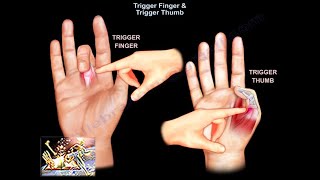 Trigger Finger amp Trigger Thumb  Everything You Need To Know  Dr Nabil Ebraheim [upl. by Risley]