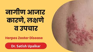 नागीण आजार लक्षणे कारणे व उपचार माहिती  डॉ सतीश उपळकर  Nagin disease symptoms in Marathi [upl. by Beatrix]