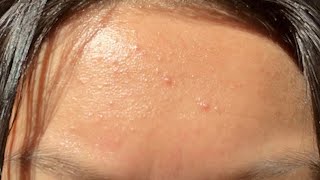 how to get rid of tiny bumps on forehead in 2 minutes [upl. by Elodia12]