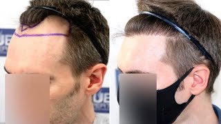 FUE Hair Transplant 1500 Grafts NW III A By Dr Juan Couto  FUEXPERT CLINIC Madrid Spain [upl. by Enttirb231]