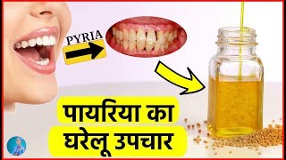 पायरिया का घरेलू इलाज │ Cure for PyriaPyorrhea Gums [upl. by Anse]