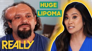 Dr Lee Removes A HUGE Lipoma From A Patients Head  Dr Pimple Popper [upl. by Naujud]