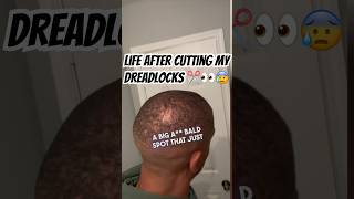 From Dreadlocks to Bald Spots My Journey and Shocking Results hairloss alopeciajourney [upl. by Nyliahs]