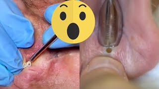 Blackhead Extractions A Satisfying Ear Cleaning Experience [upl. by Dripps]