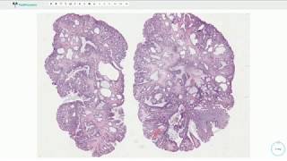 Juvenile polyp  Colon Histopathology [upl. by Leuas]