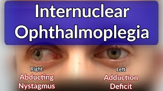 Internuclear Ophthalmoplegia  Left INO Case example explained [upl. by Enneibaf]