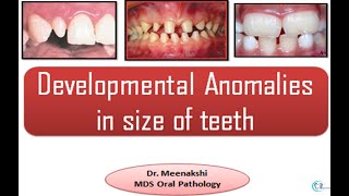 Developmental disturbances in Size of teeth [upl. by Innep]