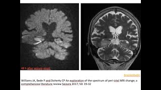 74 Postictal imaging changes excitotoxic edema hyperperfusion BBB disruption seizure related [upl. by Yerfoeg]