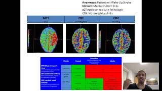 Teil 1 von 2 Befundung von CTPerfusion in NUR 4 Minuten lernen [upl. by Frederica]