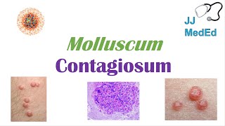 Molluscum Contagiosum “Papules with Belly Buttons” Risk factors Symptoms Diagnosis Treatment [upl. by Attenauq]