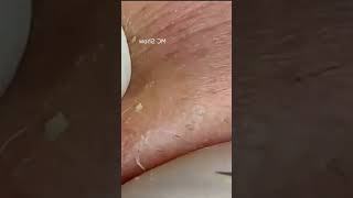 Pickel Ausdrücken Blackheads Akne amp Mitesser entfernen 🔴 15 [upl. by Estrella]