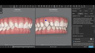 Invisalign Treatment Planning Case 1 CM [upl. by Baynebridge]