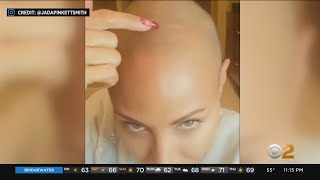 Doctors report uptick in alopecia patients coming forward for help [upl. by Akima]