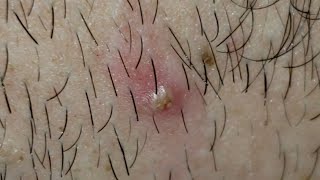 Popping Pimples on Neck and Back ASMR Pulling Ingrown Hairs Satisfying Plucking [upl. by Arayc]