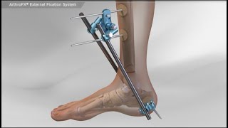 Severe Open Compound Fracture FibTib External Fixator ExFix Removal wout Anesthetics [upl. by Archie]