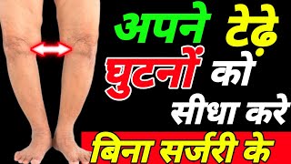 टेढ़े घुटनों को सीधा करे Knee Contractureघुटनों का गैप बढ़ाएBow Leg Treatment [upl. by Kinsley]