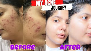 My acne journey that changes my life  How i cleared my skin in 4 months [upl. by Brigham]