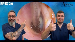 BIG EAR WAX PLUG REMOVED FROM DEEP IN THE EAR  EP1026 [upl. by Eduard768]