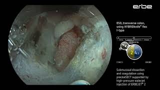 ESD of a LSTNG tumor at the splenic flexure using HYBRIDknife® flex IType [upl. by Misti360]