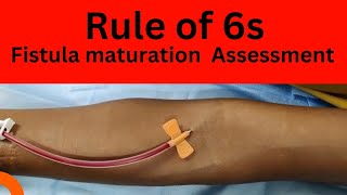 Assessment of AV fistula [upl. by Adeuga]