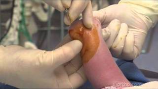 Foot Surgery The Ponseti Method for the Treatment of Clubfoot in Distal Arthrogryposis [upl. by Nicolella]