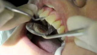 Teeth Bonding  Teeth Bonding Procedure [upl. by Philomena]