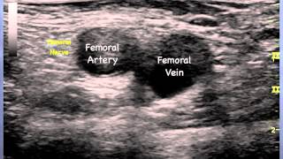 Femoral Nerve Sonoanatomy  QMH AED Ultrasound Casebook 2013 Video 12 [upl. by Bobette]