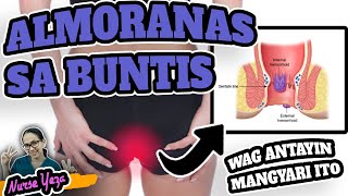 HEMORRHOIDS O ALMORANAS SA BUNTIS  LUNAS SA HEMORRHOIDS [upl. by Neenahs]