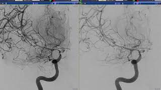 Intraarterial Treatment of Intracranial Vasospasm Nimodipine [upl. by Ardnas]