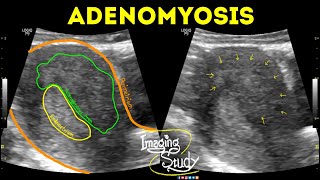 Adenomyosis  Ultrasound  Case 42 [upl. by Adirf563]