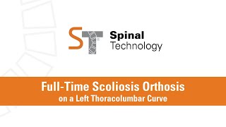 FullTime Scoliosis Orthosis on a Thoracolumbar Curve [upl. by Inavoy]