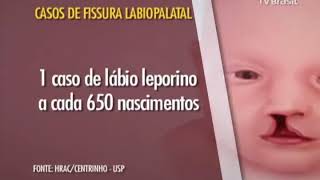 Lábio Leporino é um dos tipos mais comum de anomalia em bebês recémnascidos [upl. by Lubba]